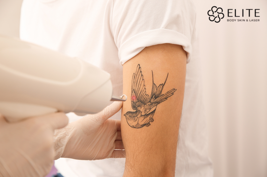 Laser Hair Removal Treatment for tattoo