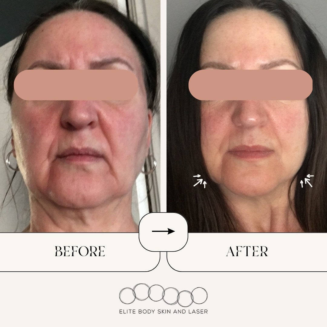 Results from ThreeForMe skin treatment