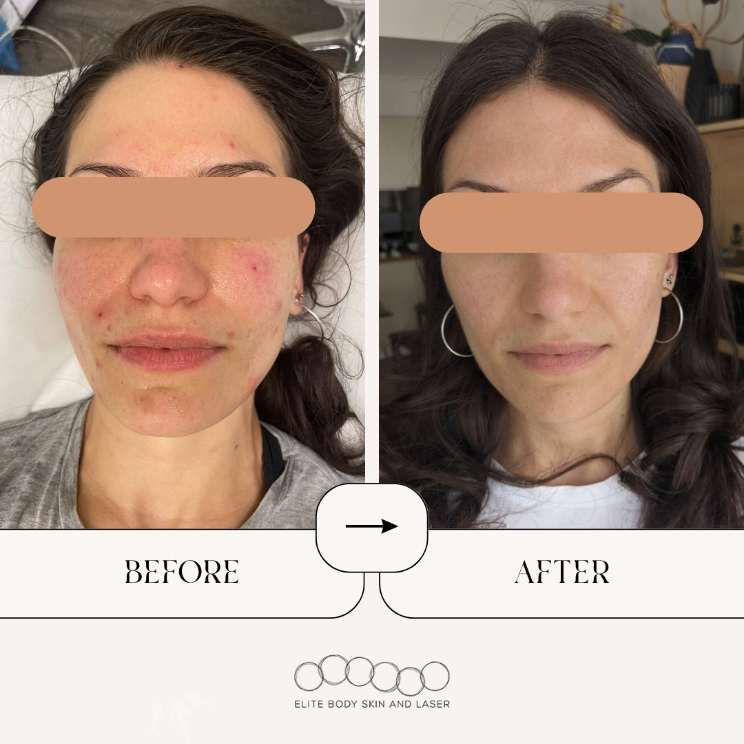 Results from RF microneedling treatment