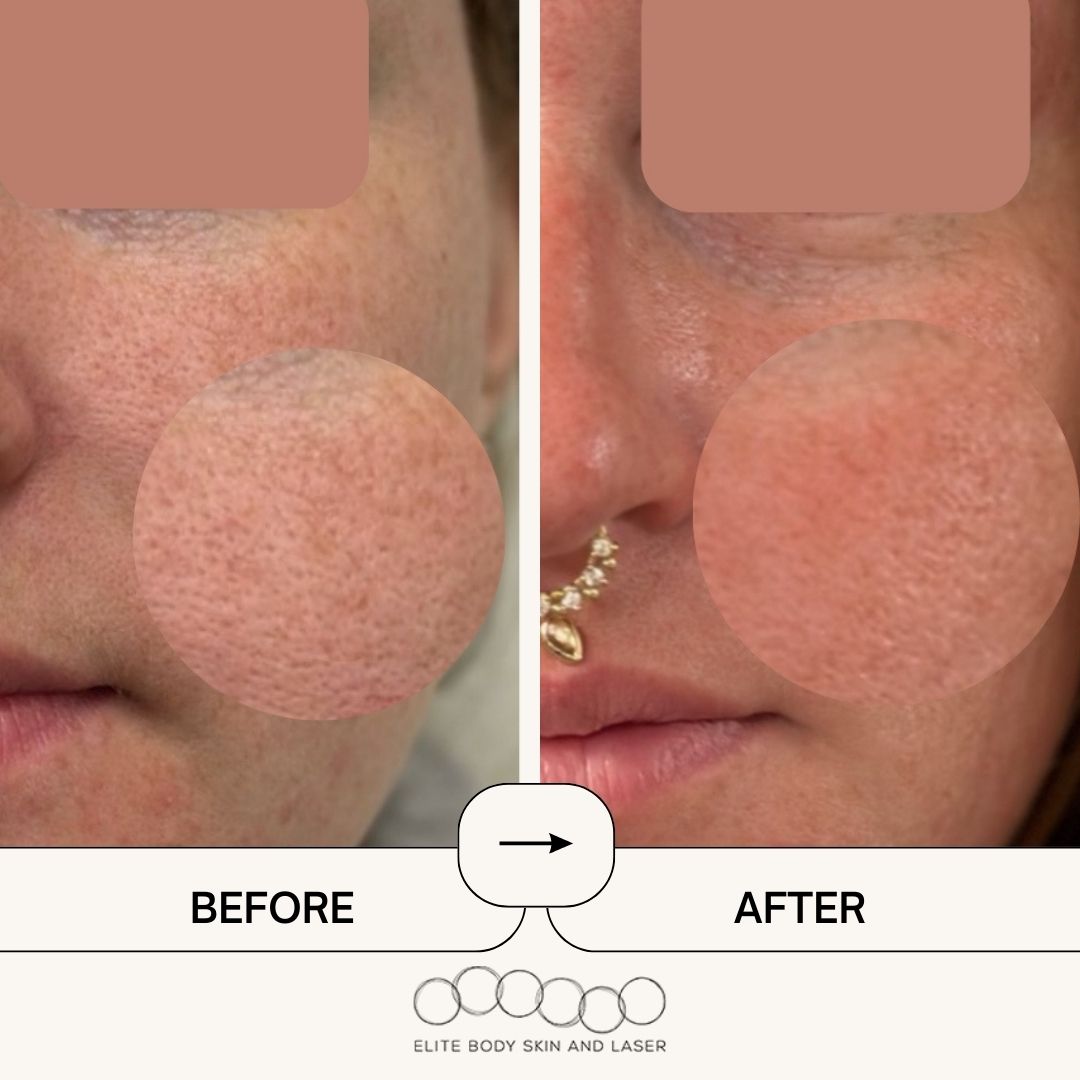 Results from RF microneedling treatment