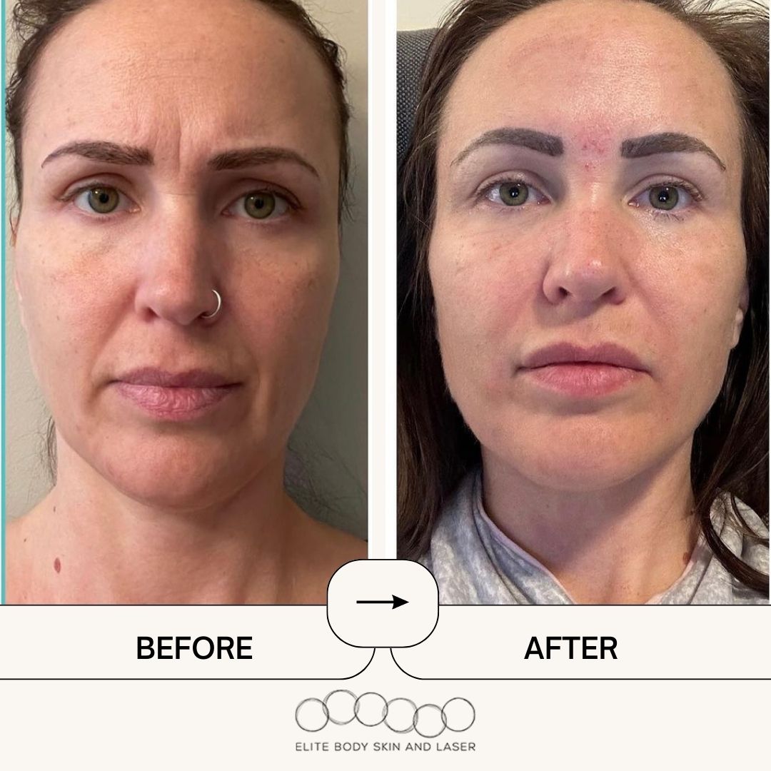 Results from RF microneedling treatment