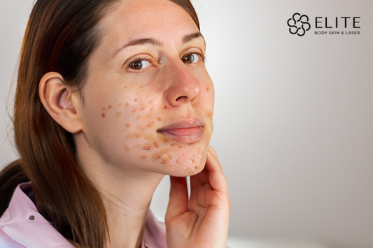 Complete Guide to Acne Scar Treatment in Canada