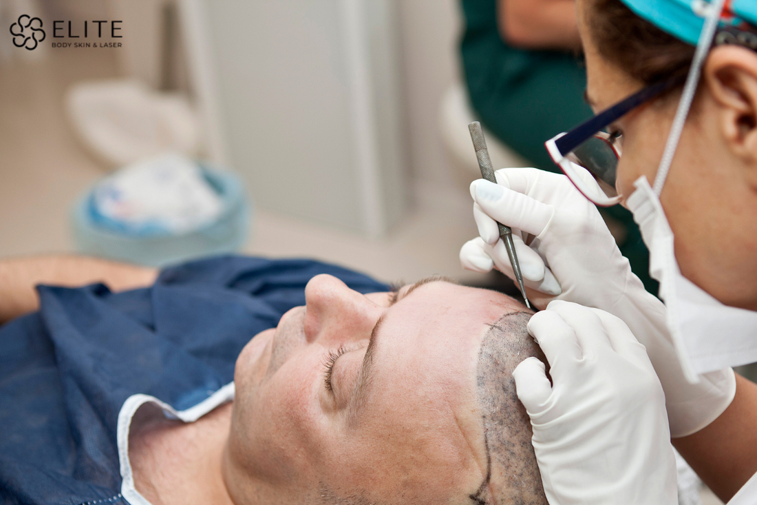 Exosome Hair Restoration in Chilliwack