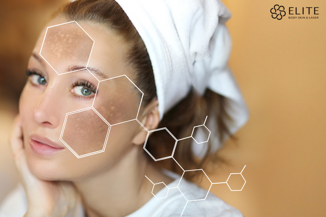 Hyperpigmentation treatments