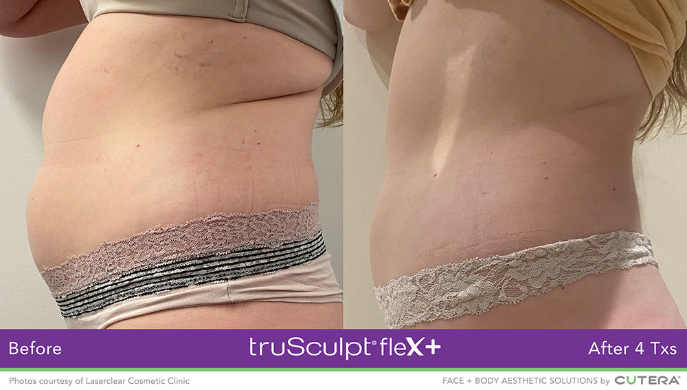 Results from truSculpt Flex treatment