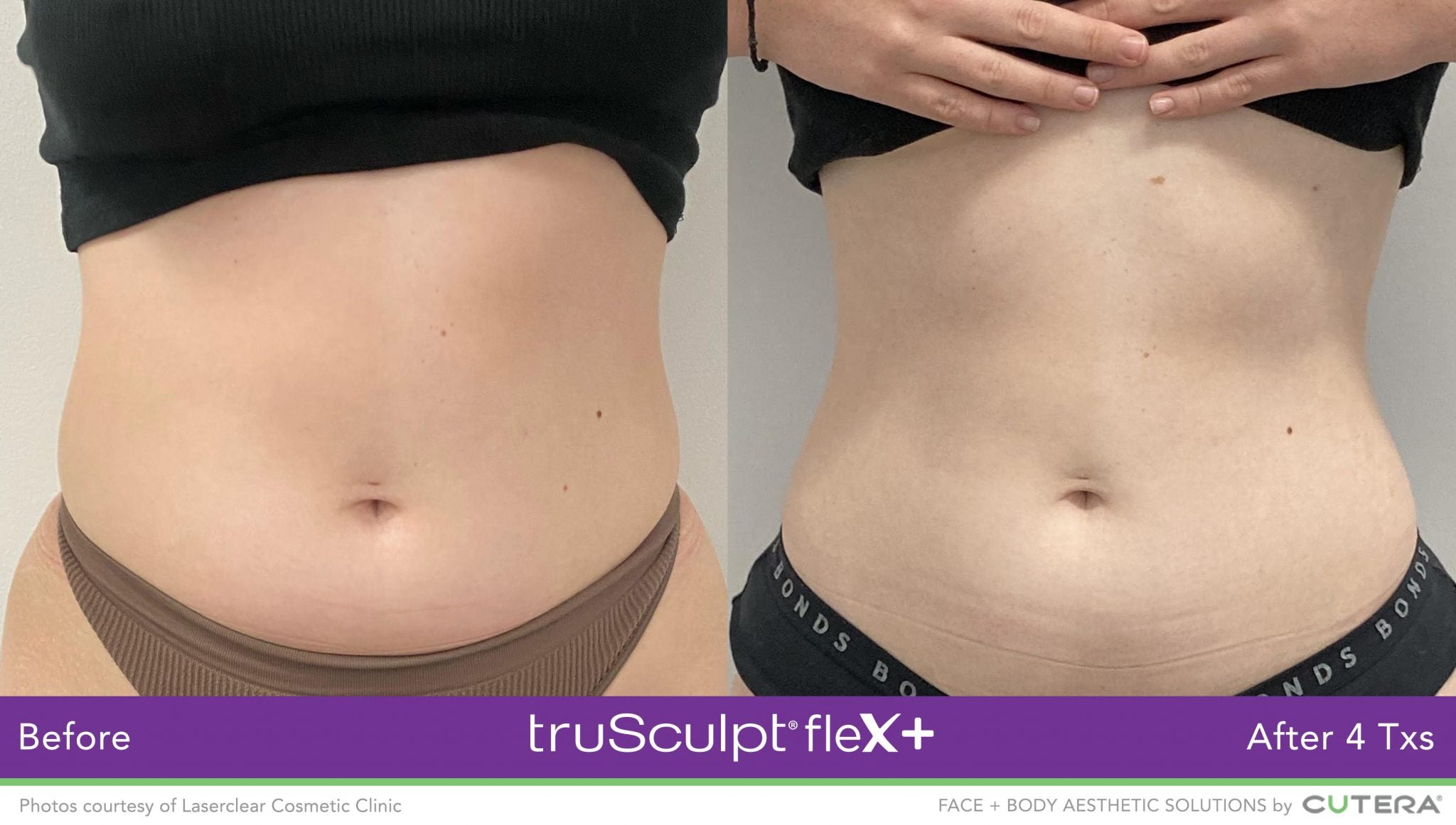 Results from truSculpt Flex treatment