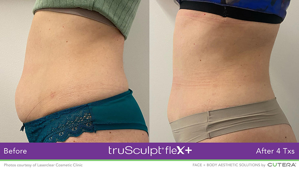 Results from truSculpt Flex treatment