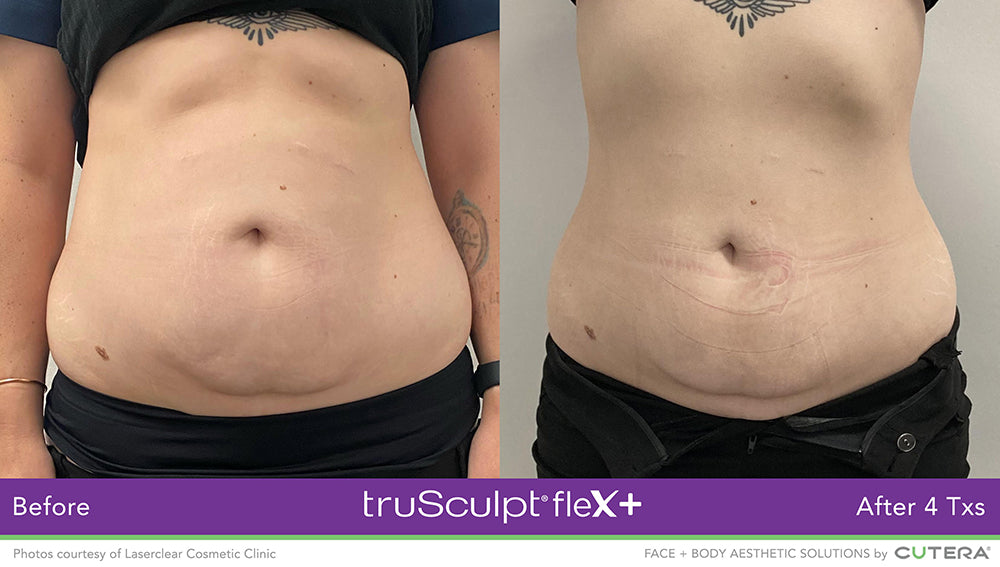 Results from truSculpt Flex treatment