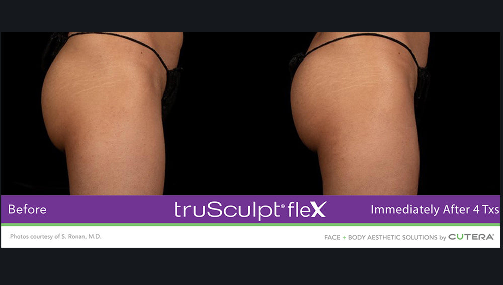 Results from truSculpt Flex treatment