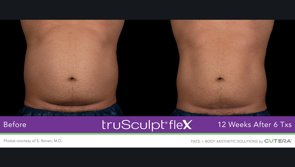 Results from truSculpt Flex treatment