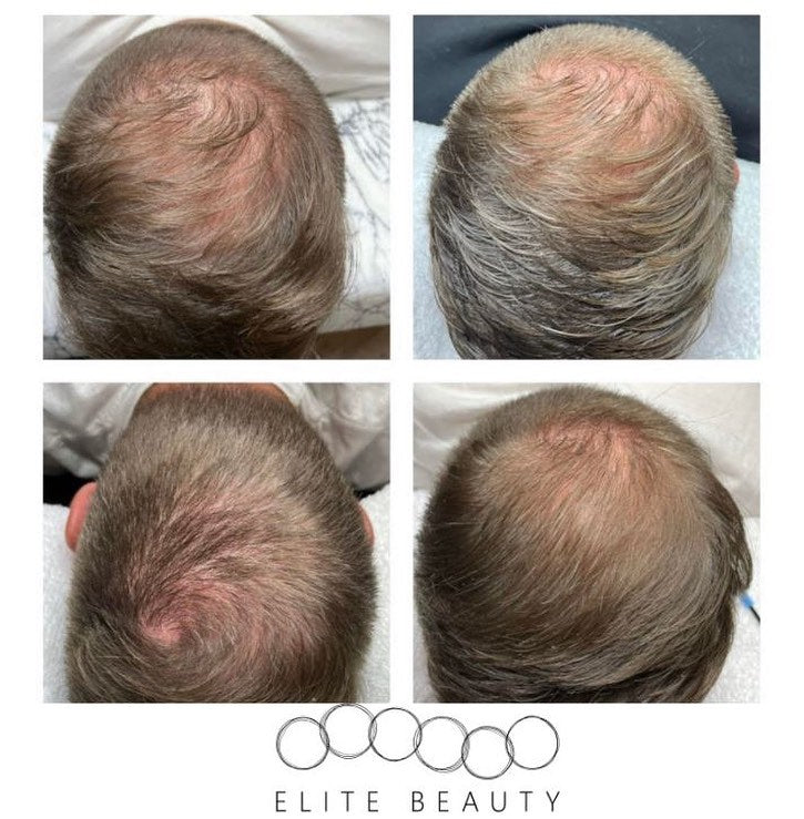 Results from hair loss treatment at Elite Body Skin & Laser