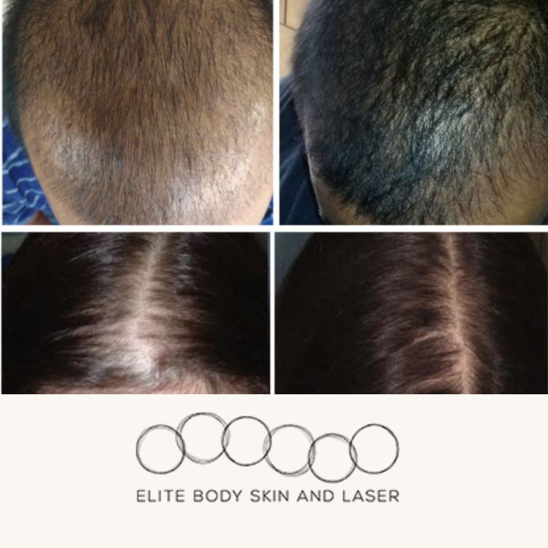 Results from hair loss treatment at Elite Body Skin & Laser