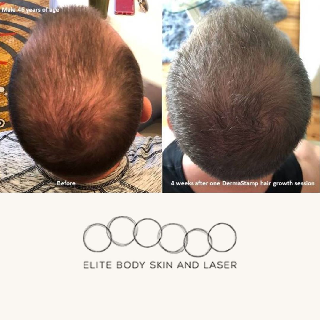 Results from hair loss treatment at Elite Body Skin & Laser