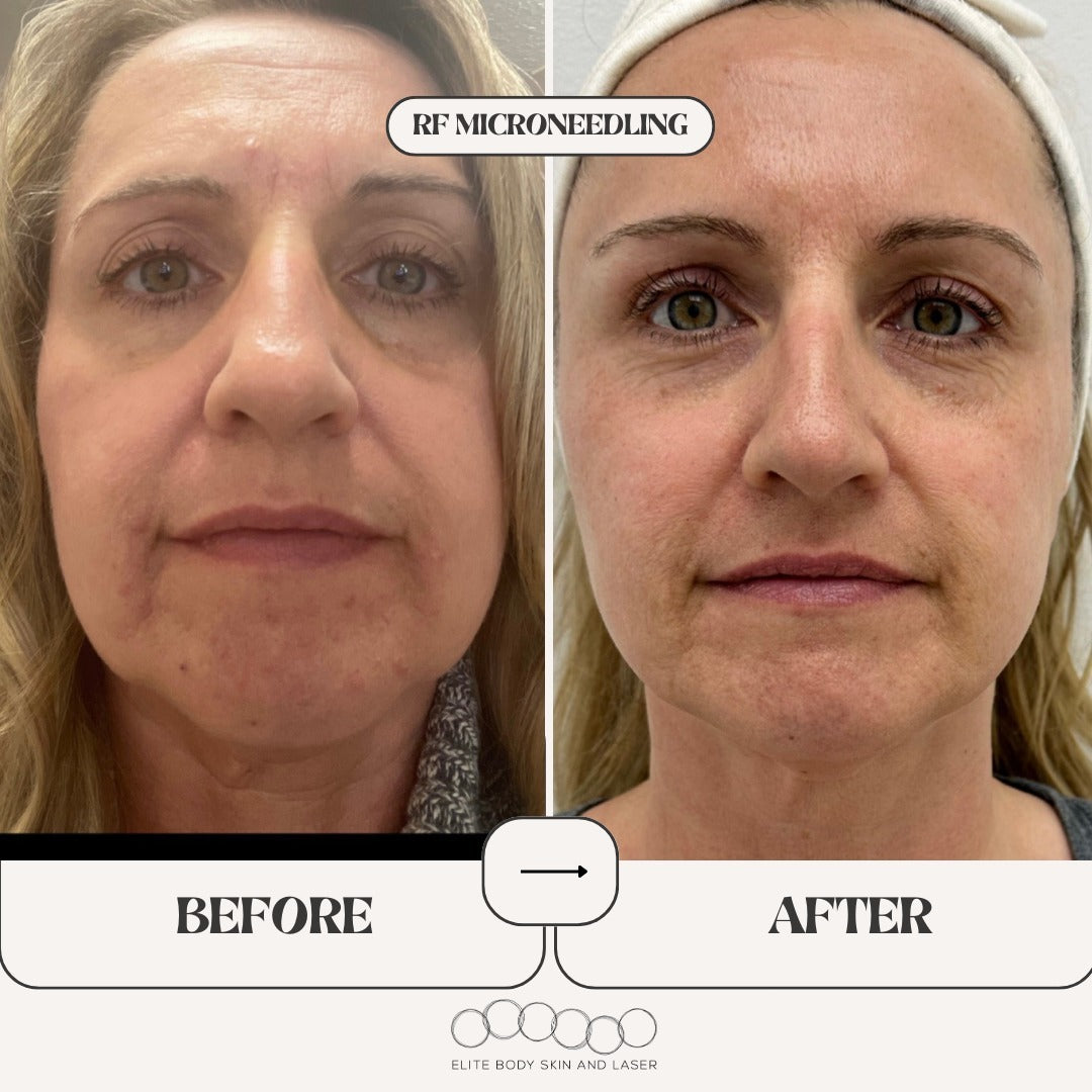 Results from RF microneedling treatment