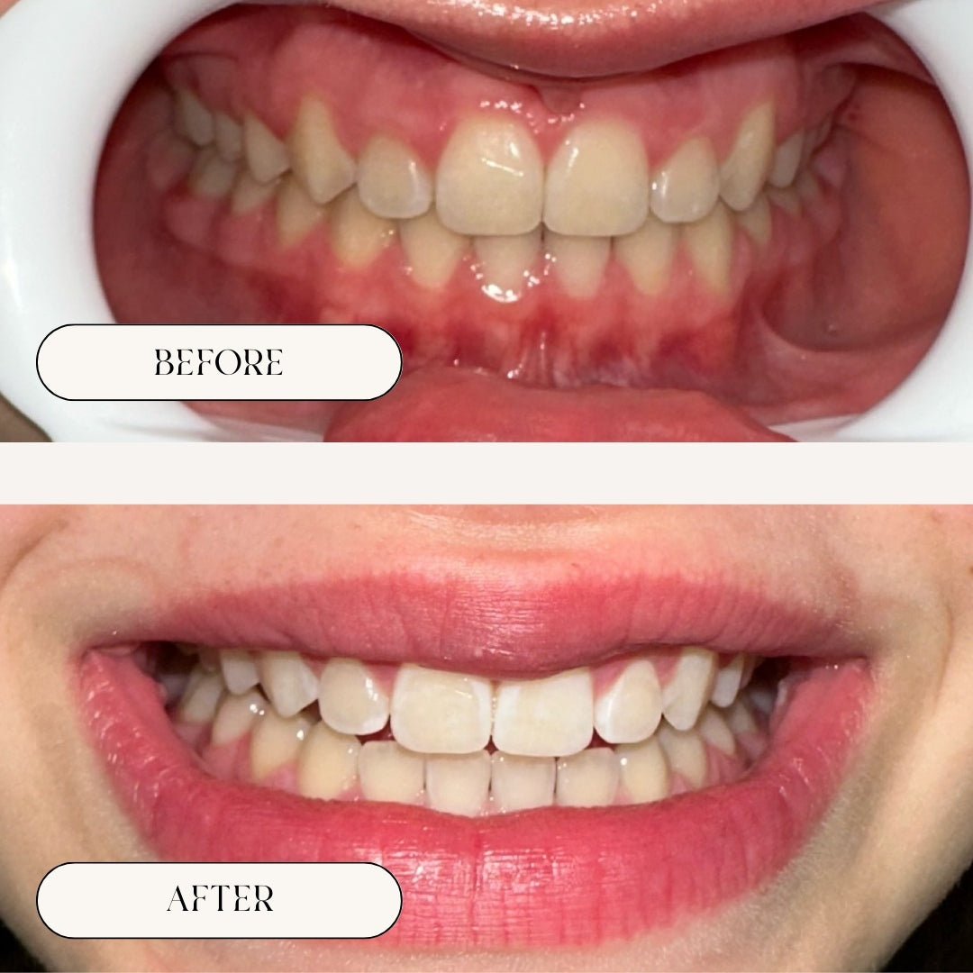 Results from Teeth Whitening treatment