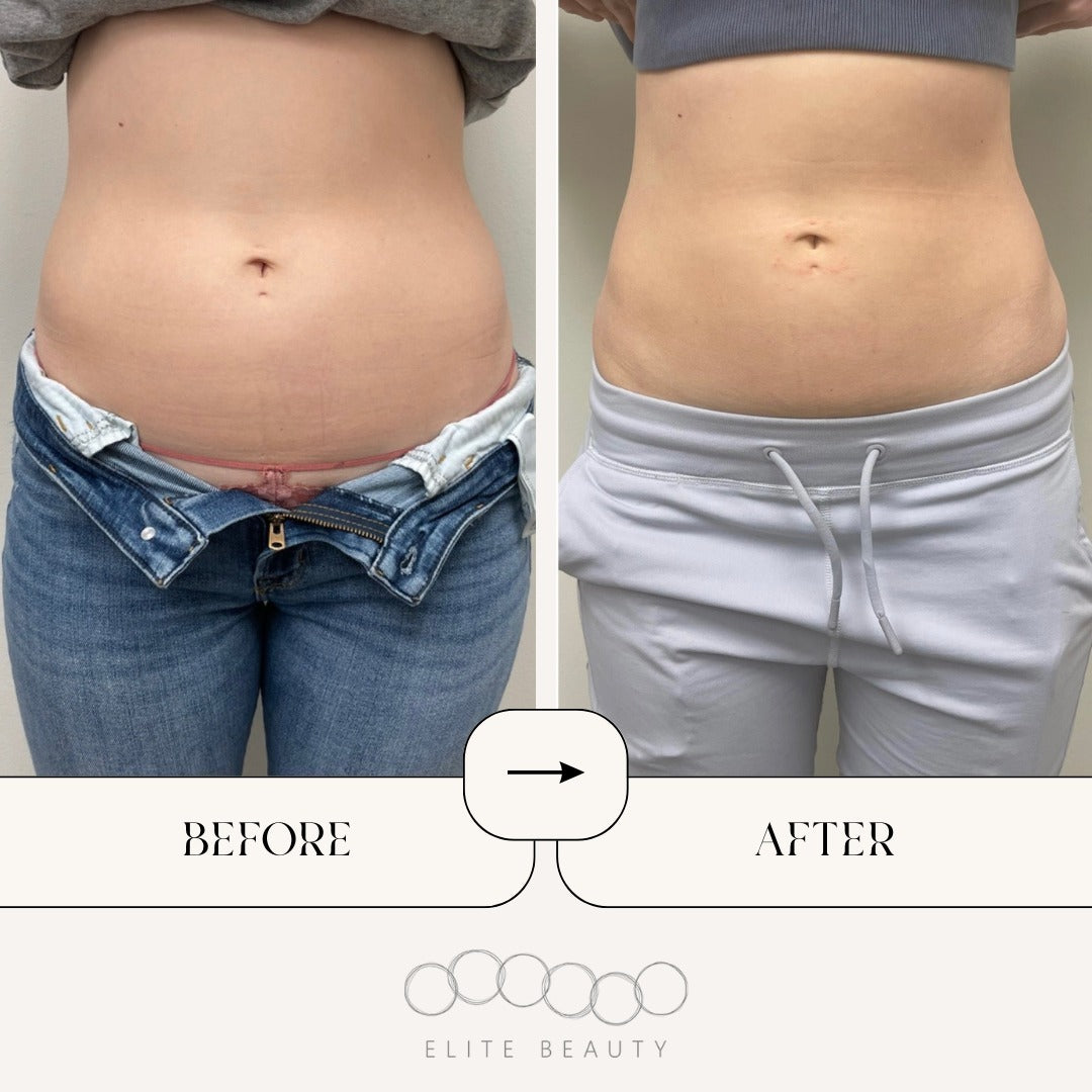 truSculpt ID Results for Body Slimming