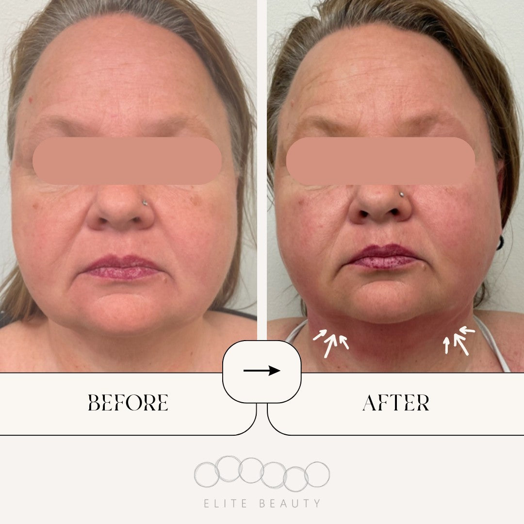 truSculpt ID Results for Double Chin