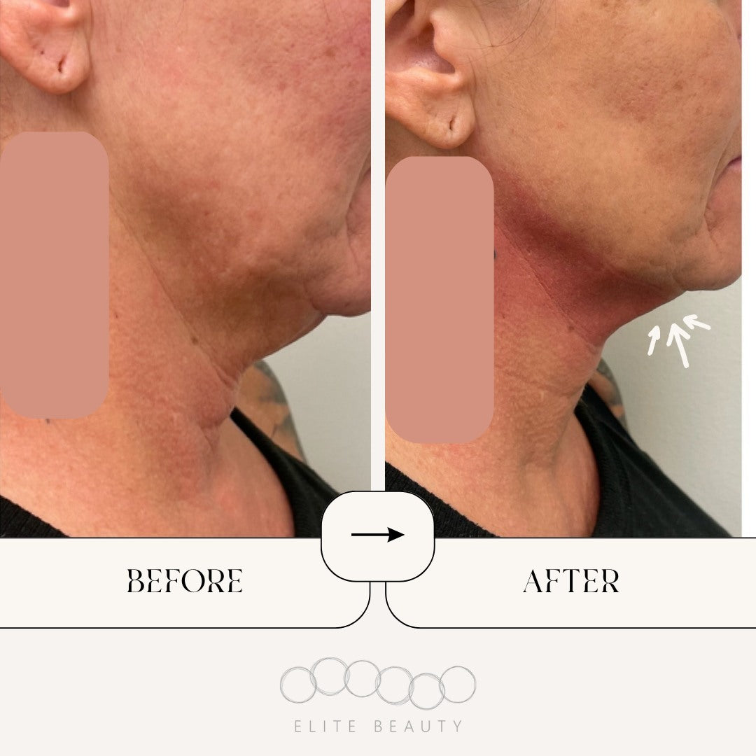 truSculpt ID Results for Double Chin