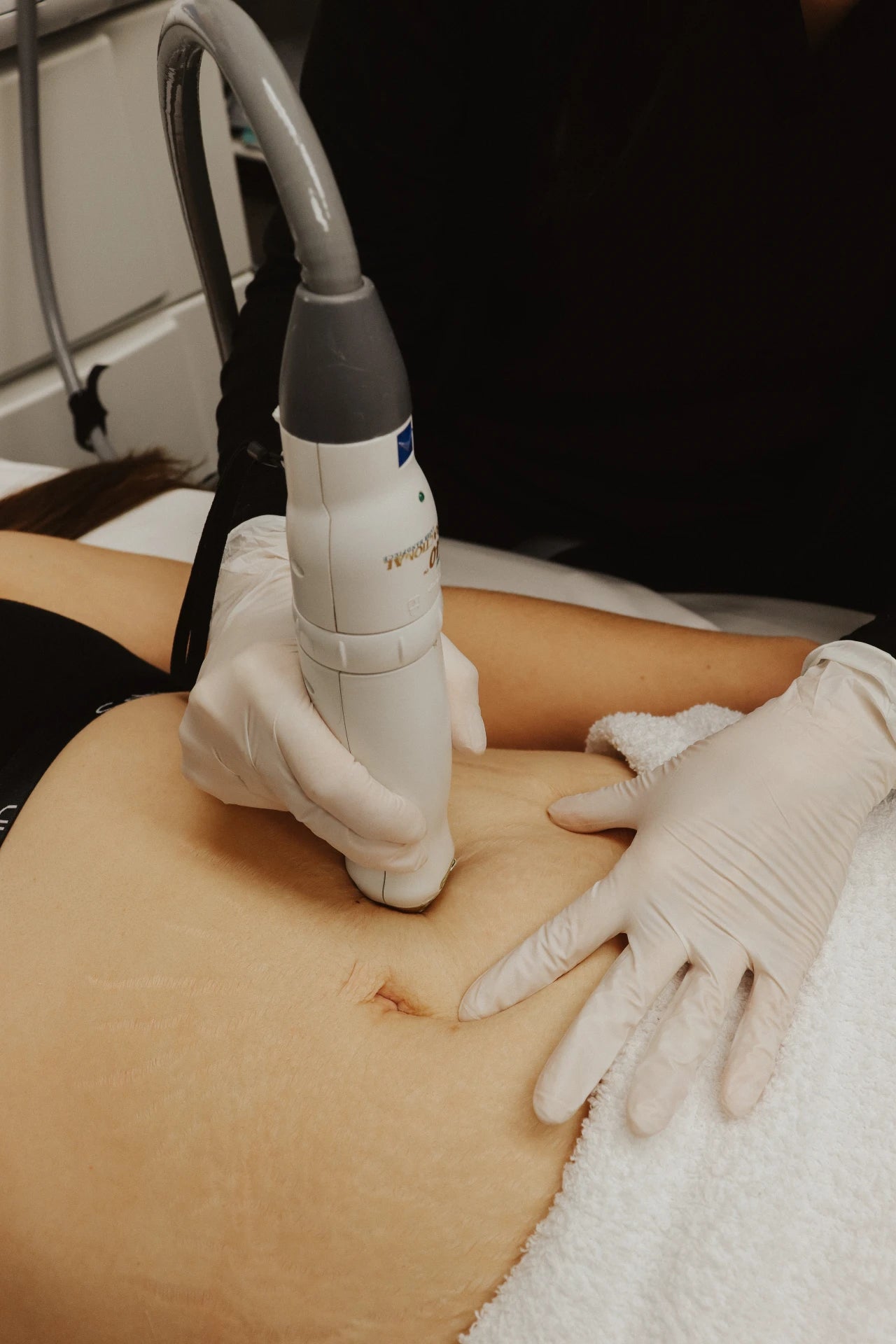 Woman receiving Icon 1540 laser treatment on the body