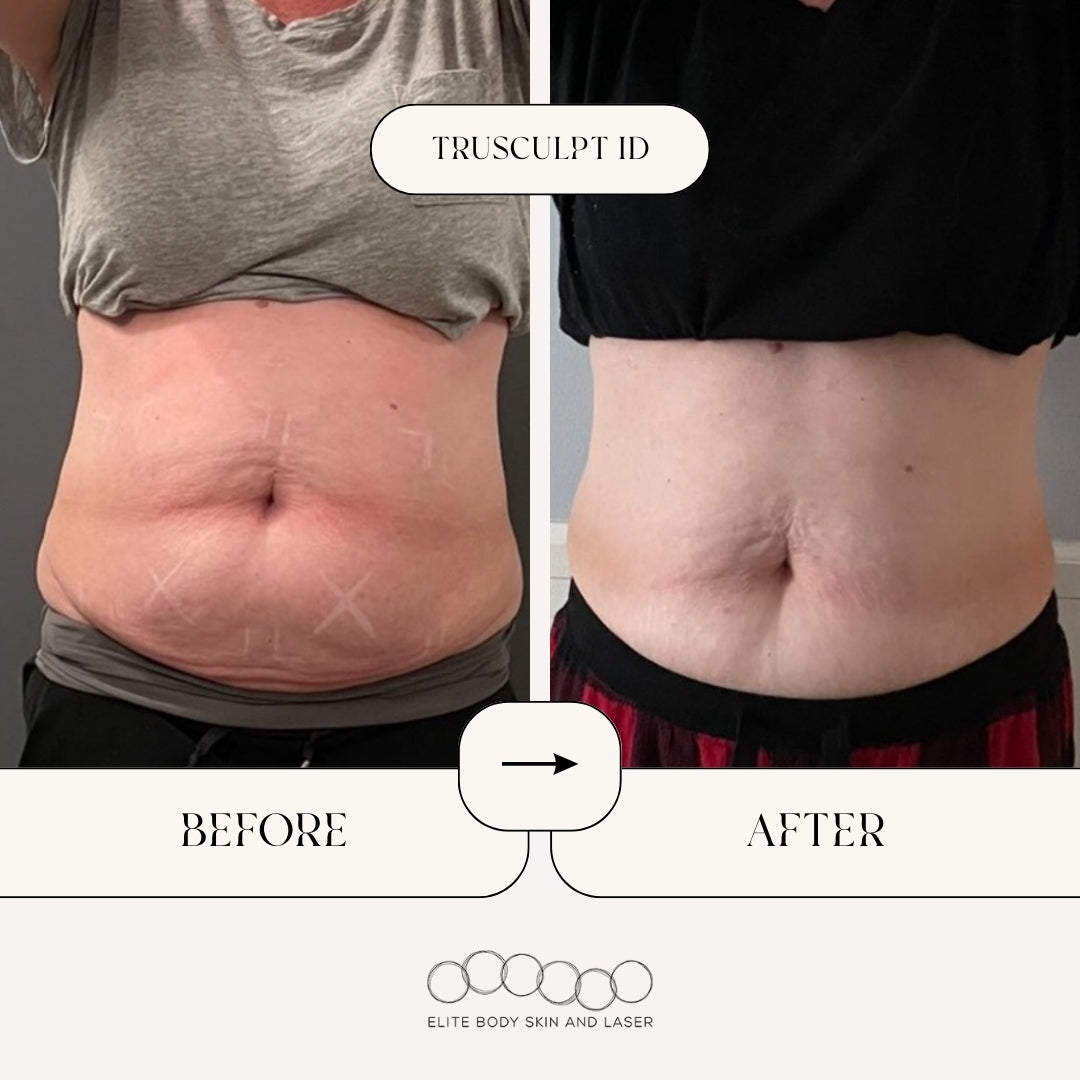 truSculpt ID Results for Stubborn Fat